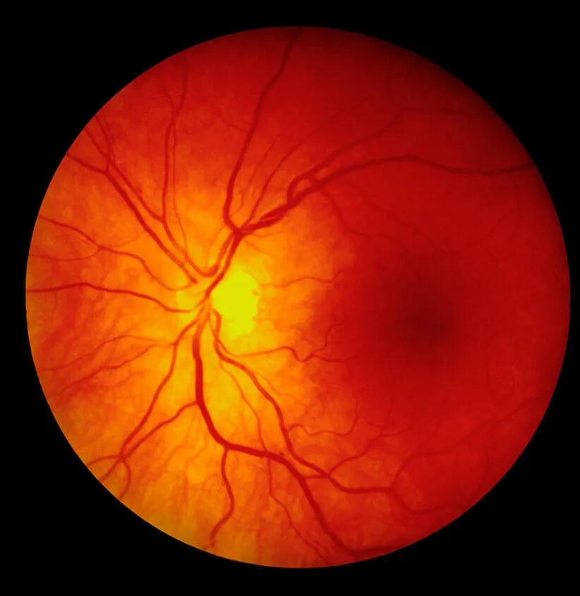 degeneracija zute mrlje macular degeneration
