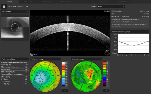 oct pahimetrija podgorica crna gora oftalmoloski centar dr raonic oftalmolog oftalmohirurg OCT pachymetry Montenegro Ophthalmology center ophthalmologist ophthalmic surgeon