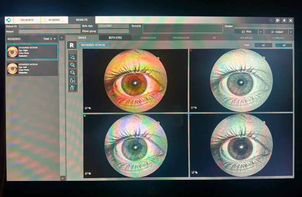 snimak prednjeg segmenta oka crna gora podgorica oftalmoloski centar dr raonic image of the anterior segment of the eye Montenegro Ophthalmology center fotografija prednjeg segmenta oka